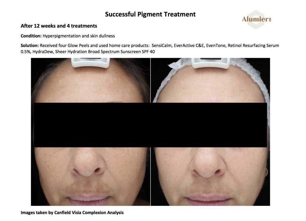 Successful AlumierMD Pigment Treatment Results
