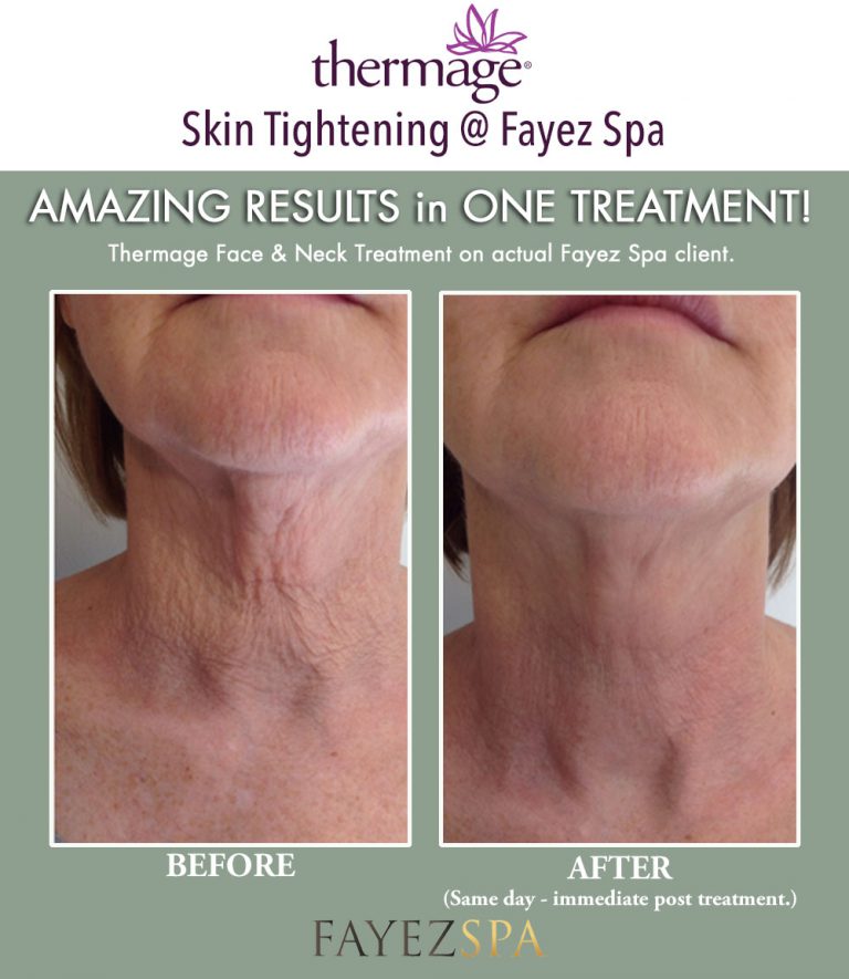 thermage-skin-tightening